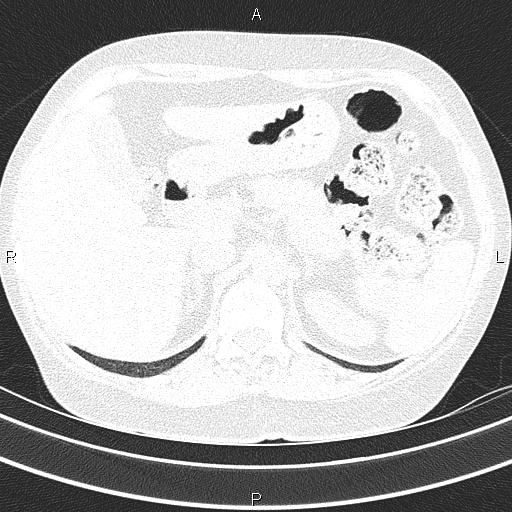 Non-specific interstitial pneumonia (Radiopaedia 83185-97567 Axial lung window 64).jpg