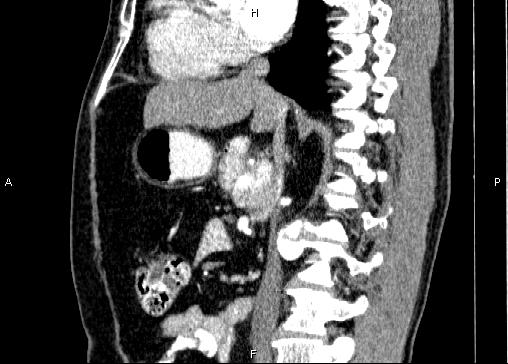 Non-syndromic pancreatic endocrine tumor (Radiopaedia 86958-103178 E 49).jpg