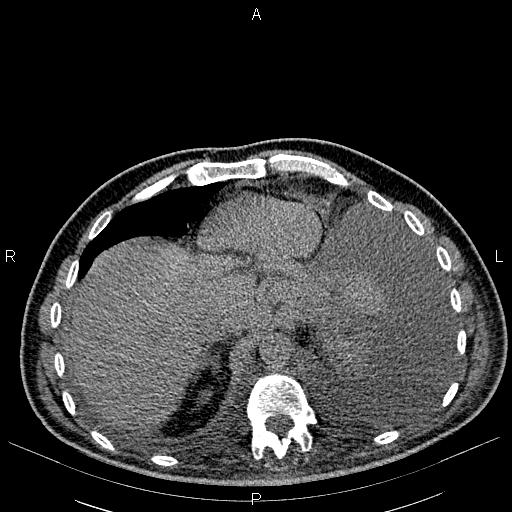 File:Non Hodgkin lymphoma in a patient with ankylosing spondylitis (Radiopaedia 84323-99621 Axial non-contrast 25).jpg