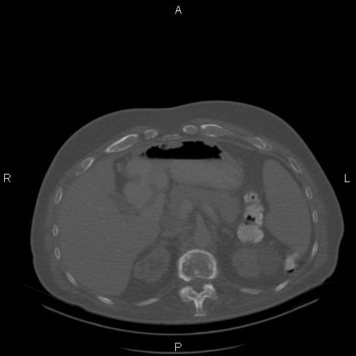 Non Hodgkin lymphoma in a patient with ankylosing spondylitis (Radiopaedia 84323-99624 Axial bone window 32).jpg