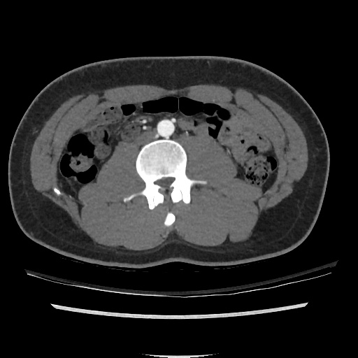 File:Normal CT angiogram of pelvis (Radiopaedia 45390-49430 A 6).jpg