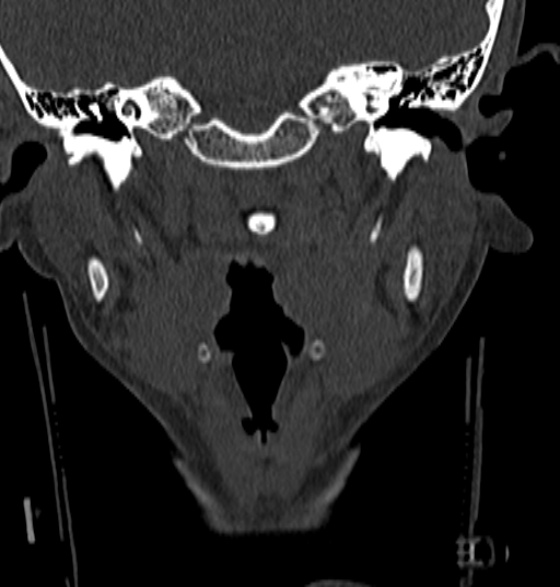 File:Normal CT cervical spine - 12-year-old (Radiopaedia 55352-61775 Coronal bone window 18).jpg