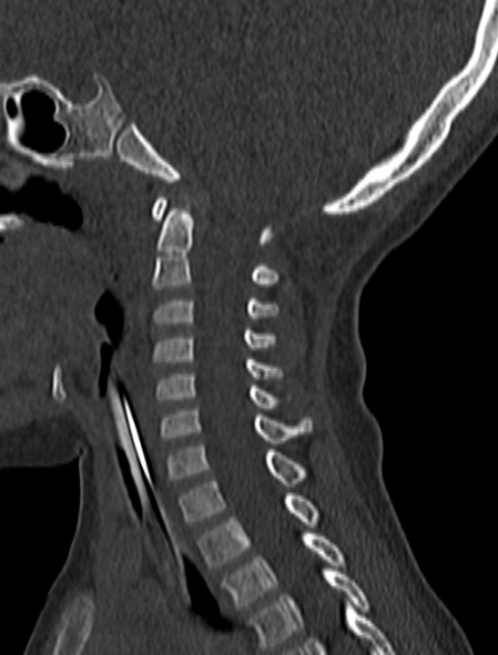 Normal CT cervical spine - pediatric (Radiopaedia 52549-58462 Sagittal bone window 114).jpg