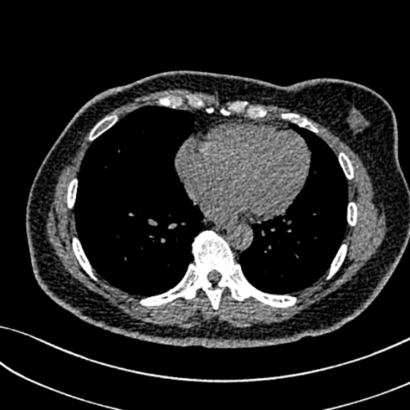 Normal CT chest- adult female (Radiopaedia 52522-58428 Axial non-contrast 86).jpg