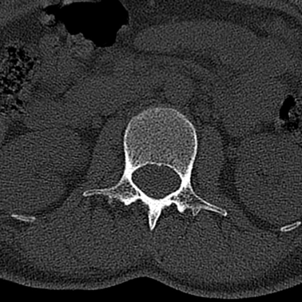 File:Normal CT lumbar spine (Radiopaedia 53981-60118 Axial bone window 24).jpg