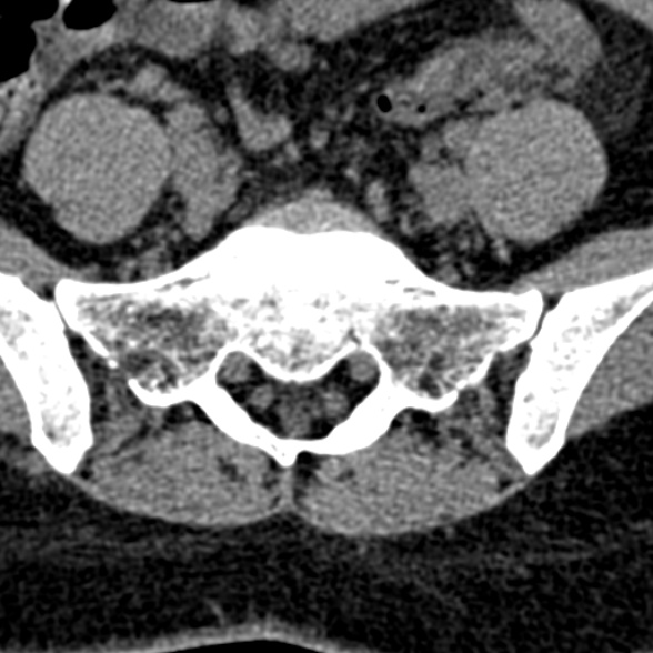 Normal CT lumbar spine (Radiopaedia 53981-60118 Axial non-contrast 92).jpg