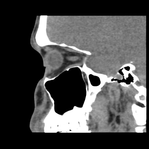 Normal CT paranasal sinuses (Radiopaedia 42286-45390 F 55).jpg