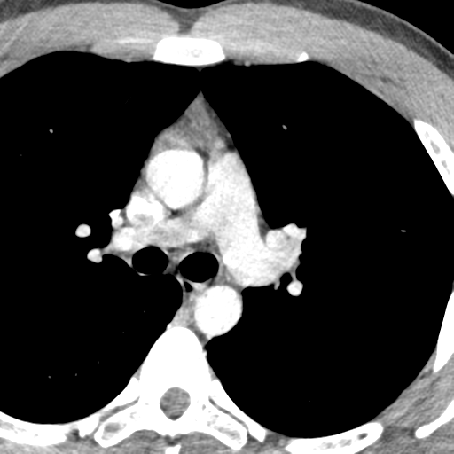 File:Normal CT pulmonary veins (pre RF ablation) (Radiopaedia 41748-44702 A 54).png
