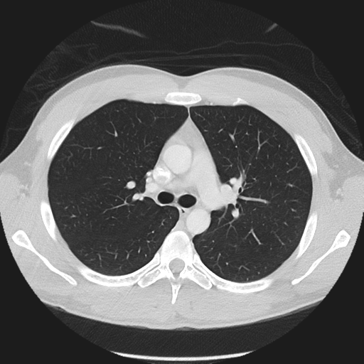 Normal CT pulmonary veins (pre RF ablation) (Radiopaedia 41748-44702 Axial lung window 9).png