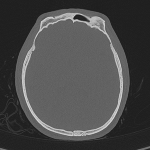 Normal CT skull (Radiopaedia 40798-43459 A 87).png