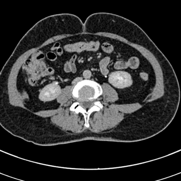 File:Normal CT split bolus study of the renal tract (Radiopaedia 48631-53634 Axial split bolus 145).jpg