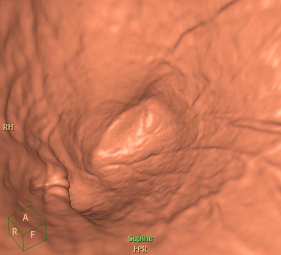File:Normal CT virtual gastroscopy (Radiopaedia 29960-30501 3D endoluminal 2).jpg