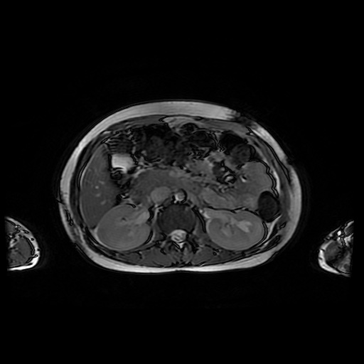 File:Normal MRI abdomen in pregnancy (Radiopaedia 88001-104541 Axial Gradient Echo 19).jpg