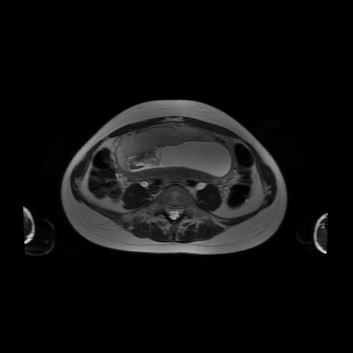 File:Normal MRI abdomen in pregnancy (Radiopaedia 88001-104541 Axial T2 43).jpg