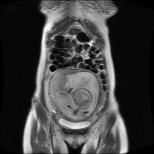File:Normal MRI abdomen in pregnancy (Radiopaedia 88001-104541 Coronal T2 9).jpg