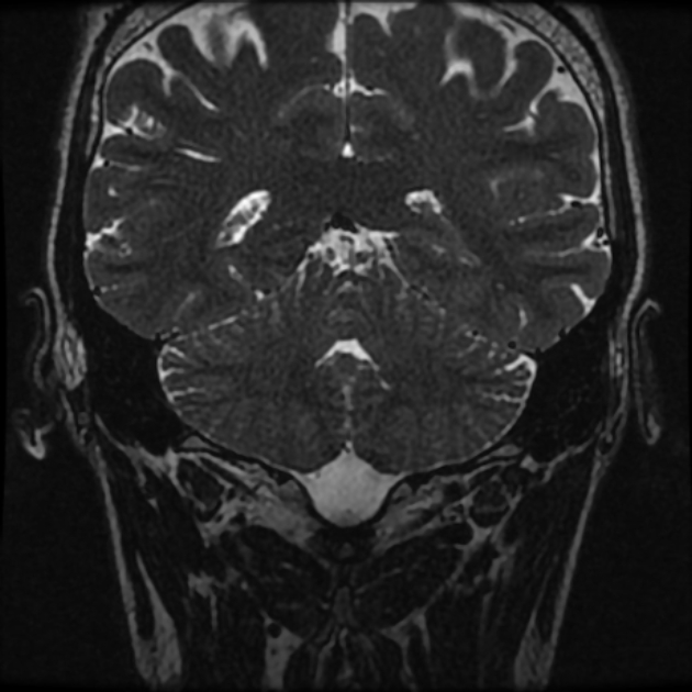 Normal MRI petrous (Radiopaedia 91317-108949 Coronal T2 92).jpg