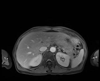 Normal adrenal glands MRI (Radiopaedia 82017-96004 M 24).jpg