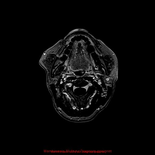 Normal adult brain MRI (non-enhanced and contrast-enhanced) (Radiopaedia 75262-86379 Axial T1 C+ 11).jpg