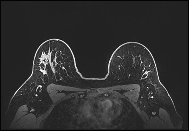 Normal breast MRI - dense breasts (Radiopaedia 80454-93850 C 166).jpg