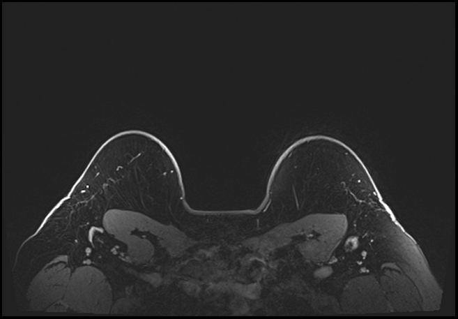 Normal breast MRI - dense breasts (Radiopaedia 80454-93850 C 204).jpg