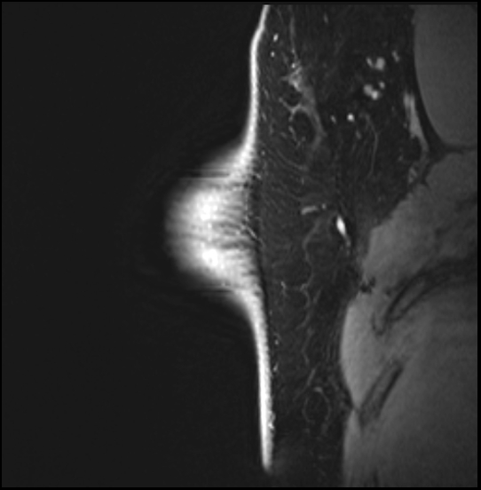 Normal breast MRI - dense breasts (Radiopaedia 80454-93850 I 41).jpg