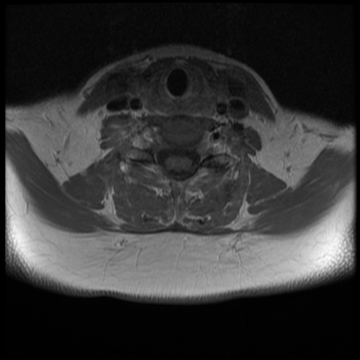 File:Normal cervical and thoracic spine MRI (Radiopaedia 35630-37156 Axial T1 C+ 13).png