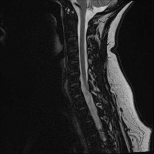 File:Normal cervical spine MRI (including Dixon) (Radiopaedia 42762-45925 Dixon- opposed phase 7).png