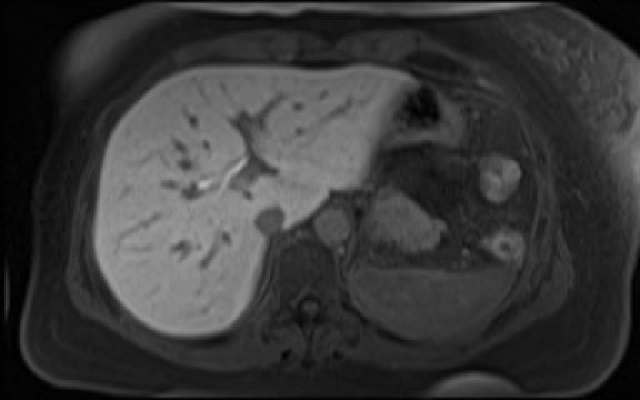 File:Normal hepatobiliary phase liver MRI (Radiopaedia 58968-66230 A 33).jpg