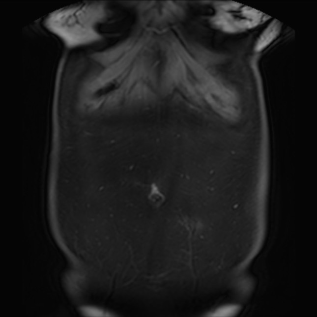 Normal liver MRI with Gadolinium (Radiopaedia 58913-66163 P 10).jpg