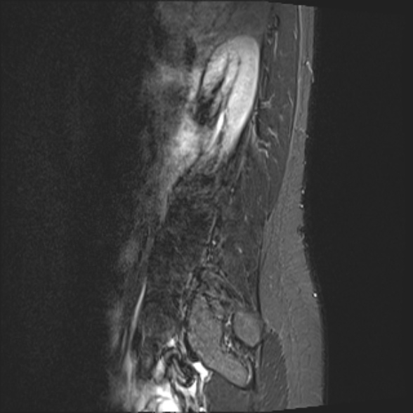 File:Normal lumbar spine MRI- 3 T (Radiopaedia 53280-59250 Sagittal STIR 1).jpg