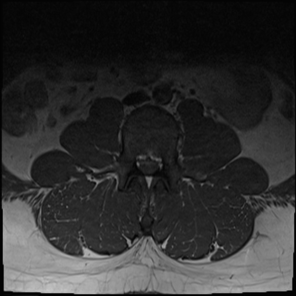 File:Normal lumbar spine MRI (Radiopaedia 47857-52609 Axial T1 2).jpg