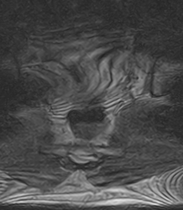 Normal lumbar spine MRI - low-field MRI scanner (Radiopaedia 40976-43699 Axial T2 108).jpg