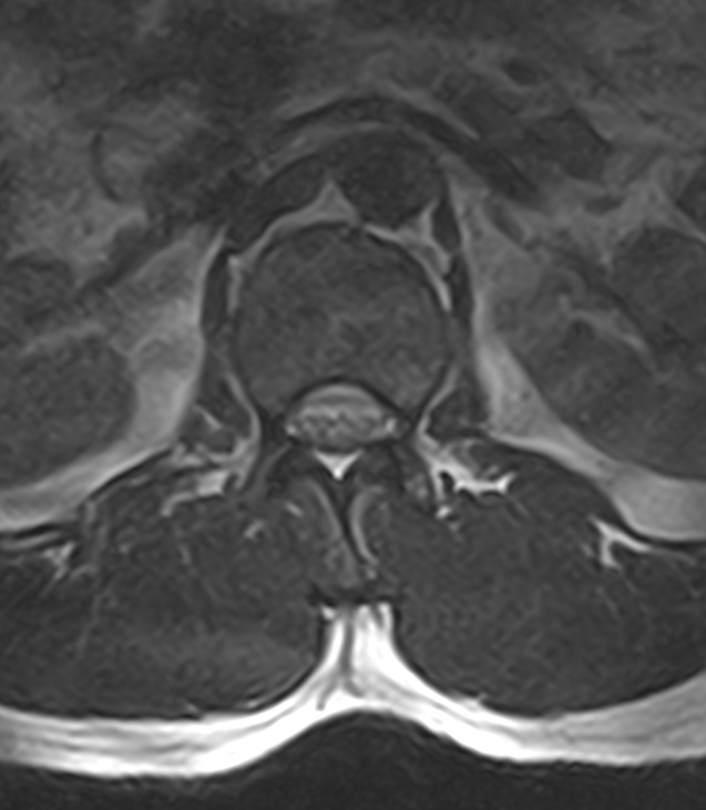 Normal lumbar spine MRI - low-field MRI scanner (Radiopaedia 40976-43699 Axial T2 22).jpg