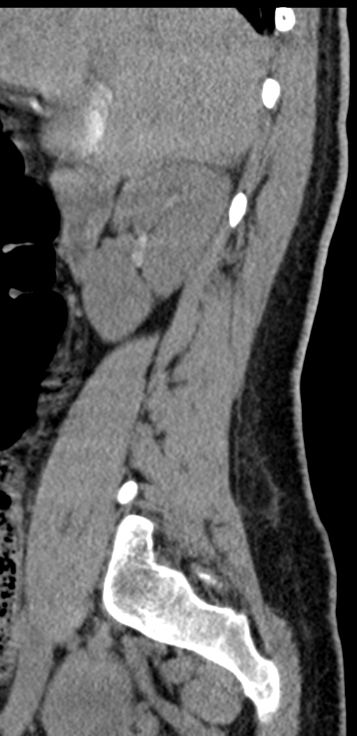 Normal lumbosacral CT (Radiopaedia 37923-39867 E 86).png