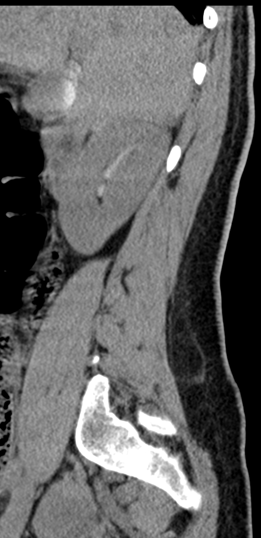 Normal lumbosacral CT (Radiopaedia 37923-39867 E 88).png