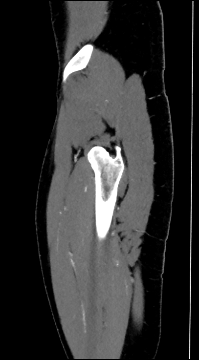 Normal pelvis CT angiogram (Radiopaedia 84966-100481 C 11).jpg