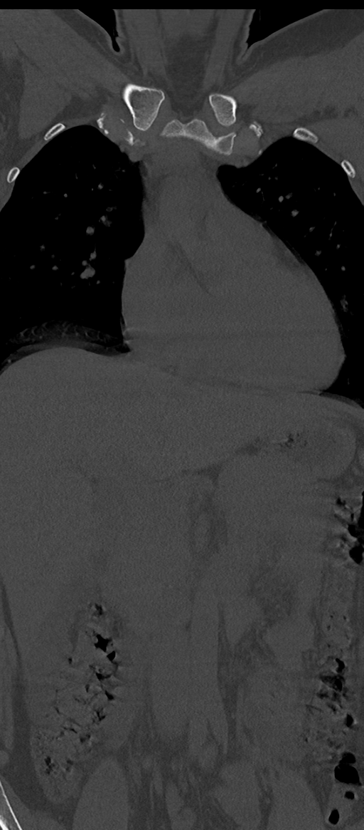 Normal thoracolumbar spine (Radiopaedia 43822-47309 Coronal bone window 14).png