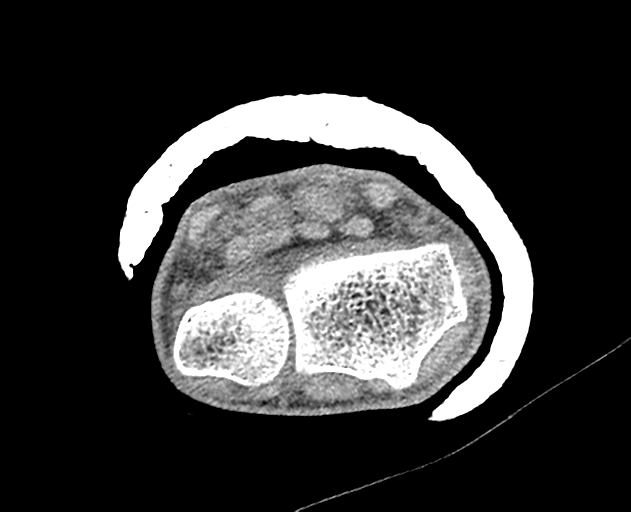 Normal wrist CT (Radiopaedia 41425-44297 Axial non-contrast 39).png