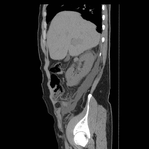 File:Obstructed kidney with perinephric urinoma (Radiopaedia 26889-27066 B 11).jpg