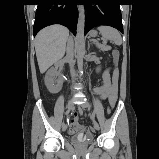 File:Obstructed kidney with perinephric urinoma (Radiopaedia 26889-27067 Coronal non-contrast 9).jpg