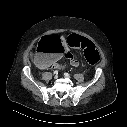 Obstructing sigmoid adenocarcinoma (Radiopaedia 58465-65619 A 118).jpg