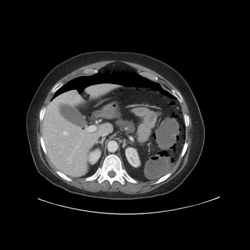 Obstructive distal colonic adenocarcinoma causing cecal perforation (Radiopaedia 86830-102989 A 56).jpg