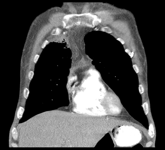 File:Obstructive superior vena cava tumor thrombus (Radiopaedia 28046-28306 B 13).jpg