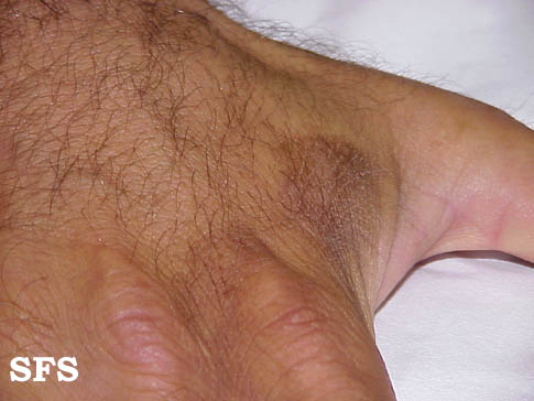 File:Phytophotodermatitis (Dermatology Atlas 7).jpg