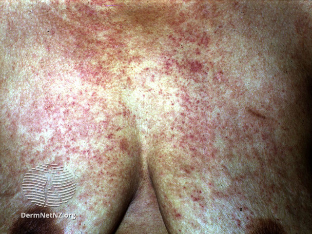 File:Purpura due to amyloidosis (DermNet NZ systemic-amyloid5).jpg