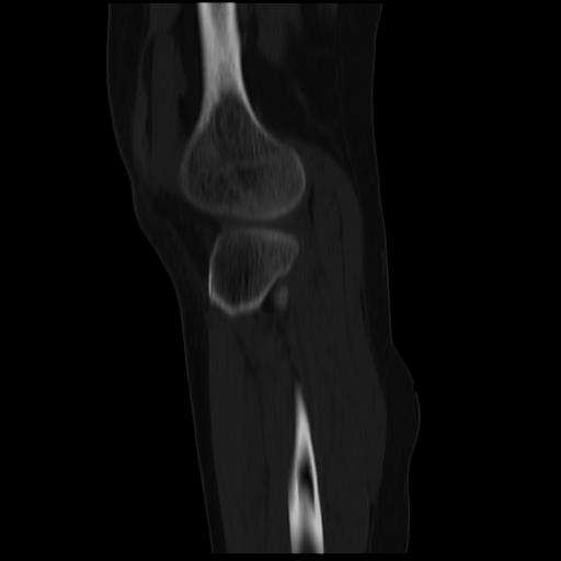 File:ACL avulsion fracture (Radiopaedia 33833-34994 Sagittal bone window 12).jpg