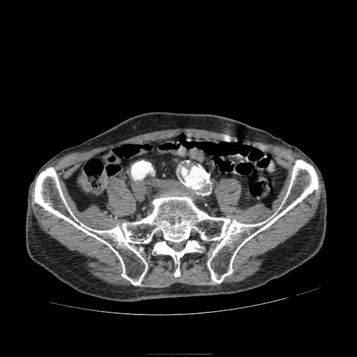 File:Abdominal aortic aneurysm (Radiopaedia 13341-13340 Axial C+ arterial phase 173).jpg