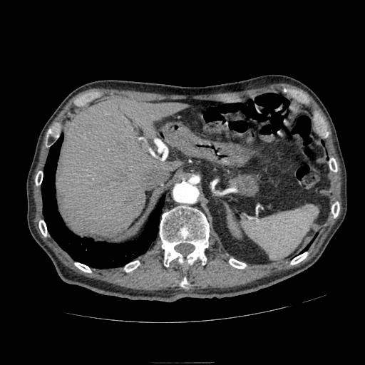 Abdominal aortic aneurysm (Radiopaedia 13341-13340 Axial C+ arterial phase 37).jpg