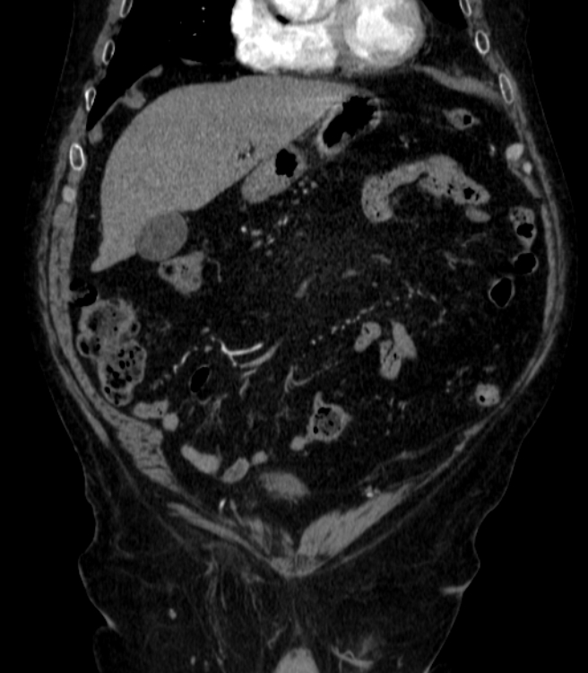 Abdominal aortic aneurysm (Radiopaedia 25855-26001 Coronal C+ arterial phase 5).jpg