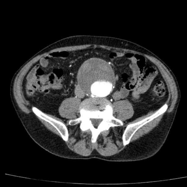 Abdominal aortic aneurysm (Radiopaedia 29248-29660 Axial C+ arterial phase 54).jpg